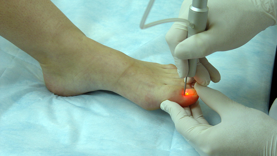 Лазерная коррекция вросшего ногтя